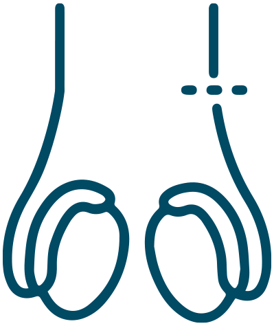 Ícone ilustrativo: Reversão de vasectomia
